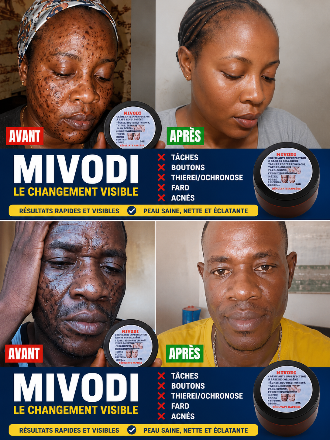 CREME MIRACLE 7J  POUR HOMME et FEMME CONTRE LES TACHES , THIEREI, ACNÉS ,BOUTONS, HYPERPIGMENTATION,PORES, ENTRE JAMBES NOIRS,FARDS, QUINTOS... LIVRAISON GRATUITE DAKAR ET ENVIRONS LES RÉGIONS 1000F PARTOUT