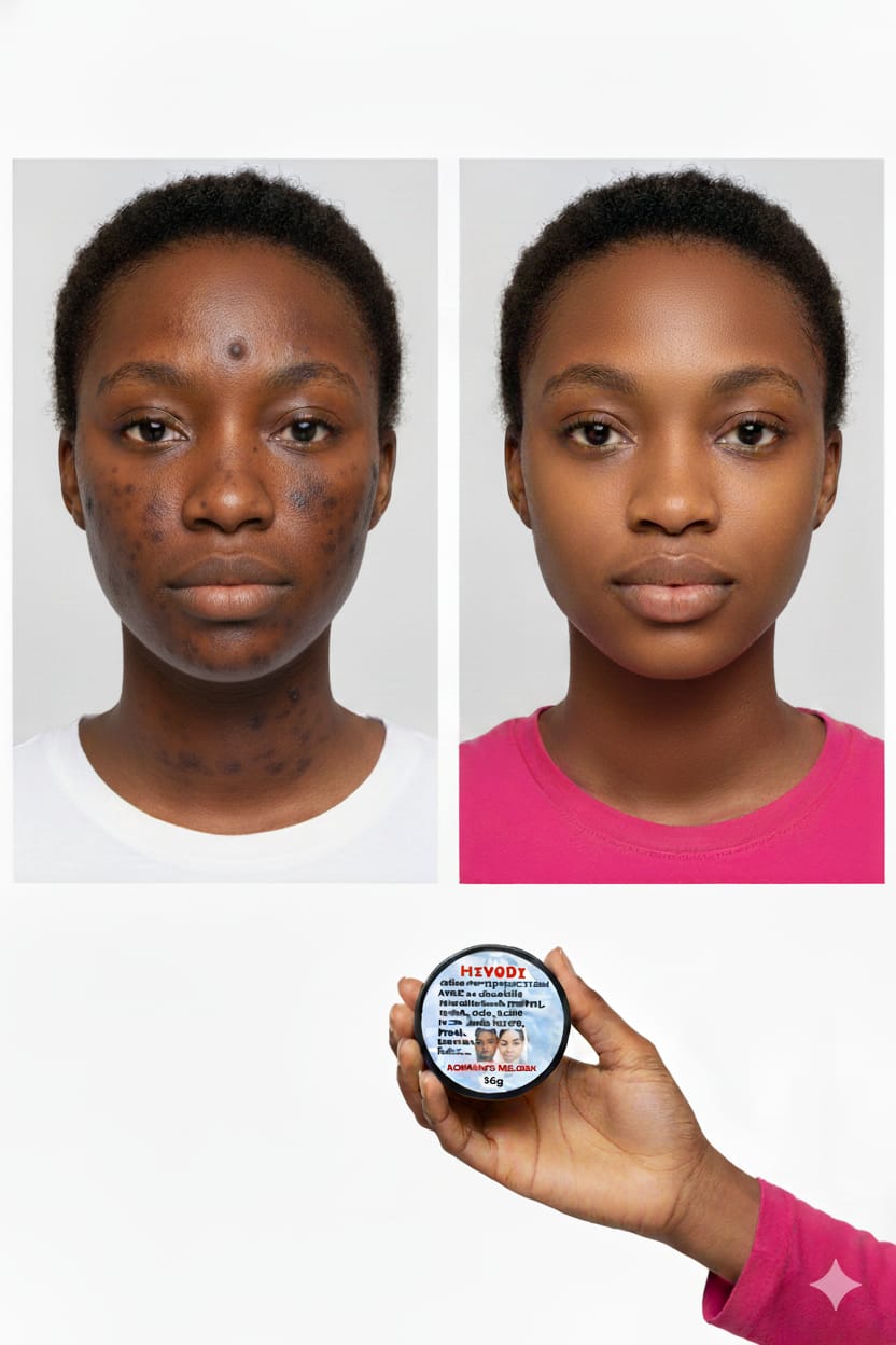 CREME MIRACLE 7J  POUR HOMME et FEMME CONTRE LES TACHES , THIEREI, ACNÉS ,BOUTONS, HYPERPIGMENTATION,PORES, ENTRE JAMBES NOIRS,FARDS, QUINTOS... LIVRAISON GRATUITE DAKAR ET ENVIRONS LES RÉGIONS 1000F PARTOUT