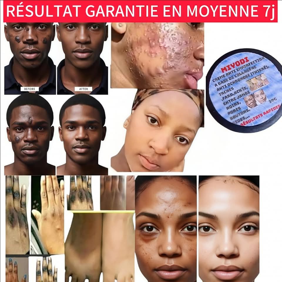 CREME MIRACLE 7J  POUR HOMME et FEMME CONTRE LES TACHES , THIEREI, ACNÉS ,BOUTONS, HYPERPIGMENTATION,PORES, ENTRE JAMBES NOIRS,FARDS, QUINTOS... LIVRAISON GRATUITE DAKAR ET ENVIRONS LES RÉGIONS 1000F PARTOUT